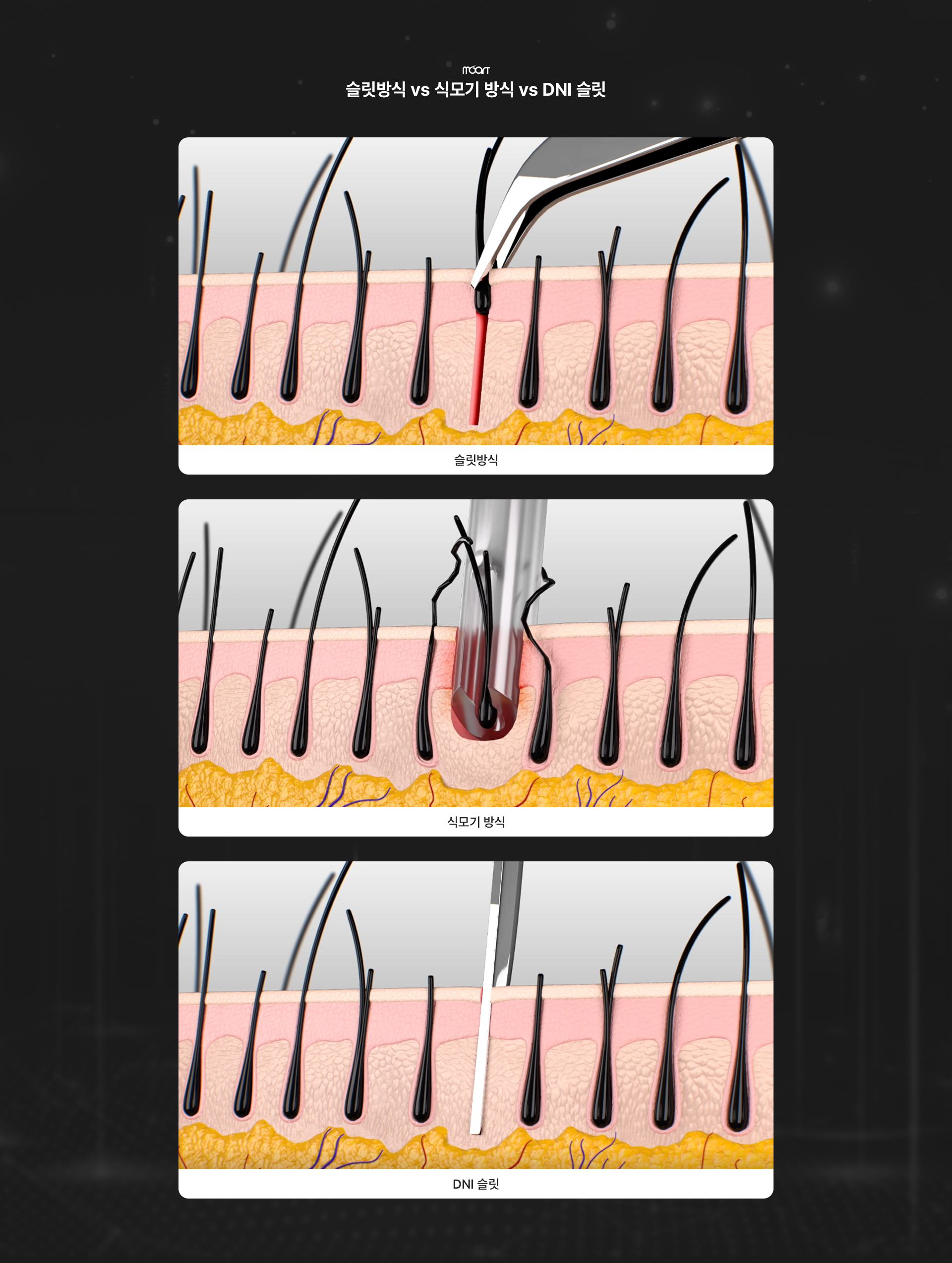 dni슬릿법 상세03