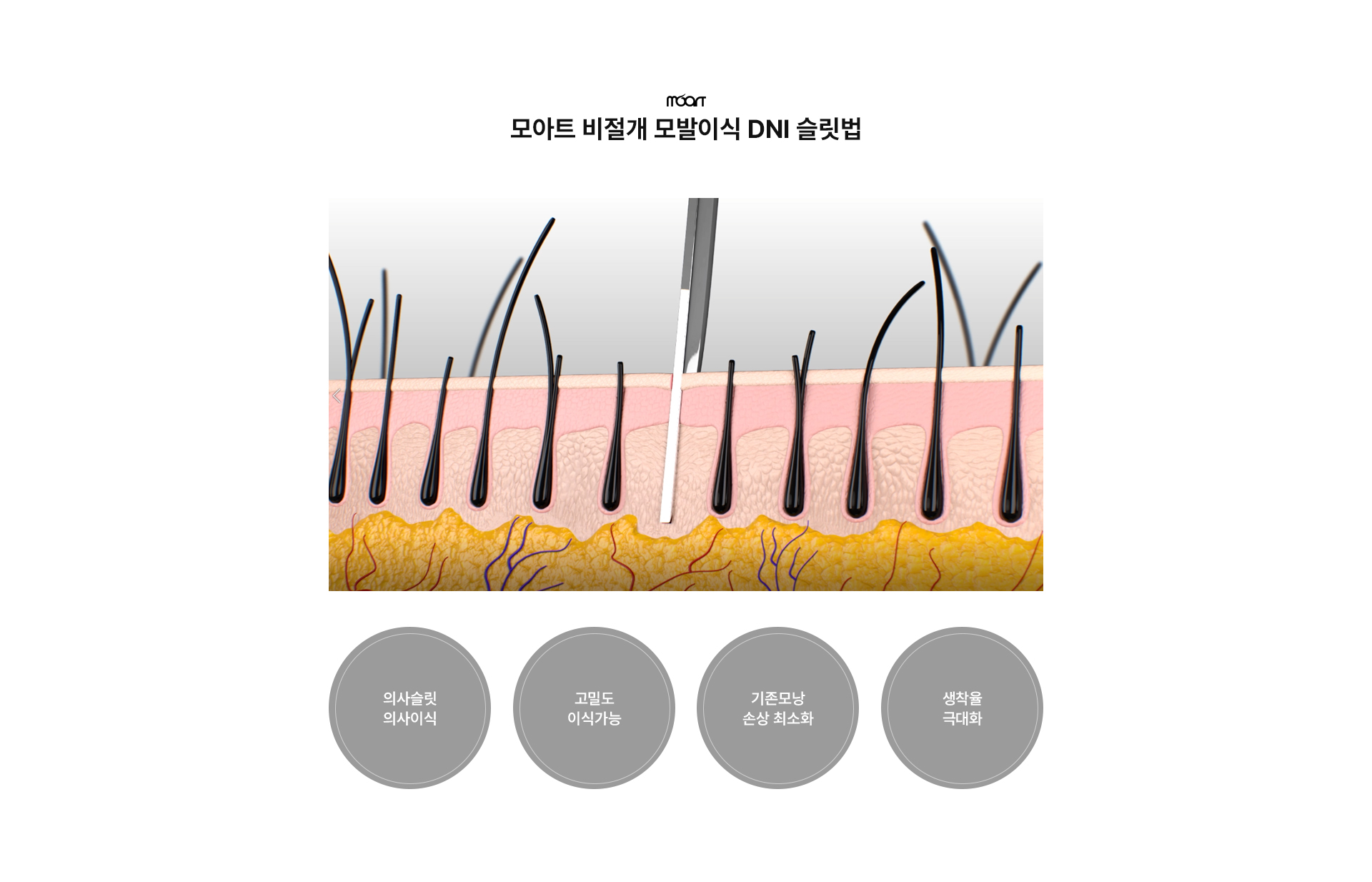 비절개 모발이식 상세04