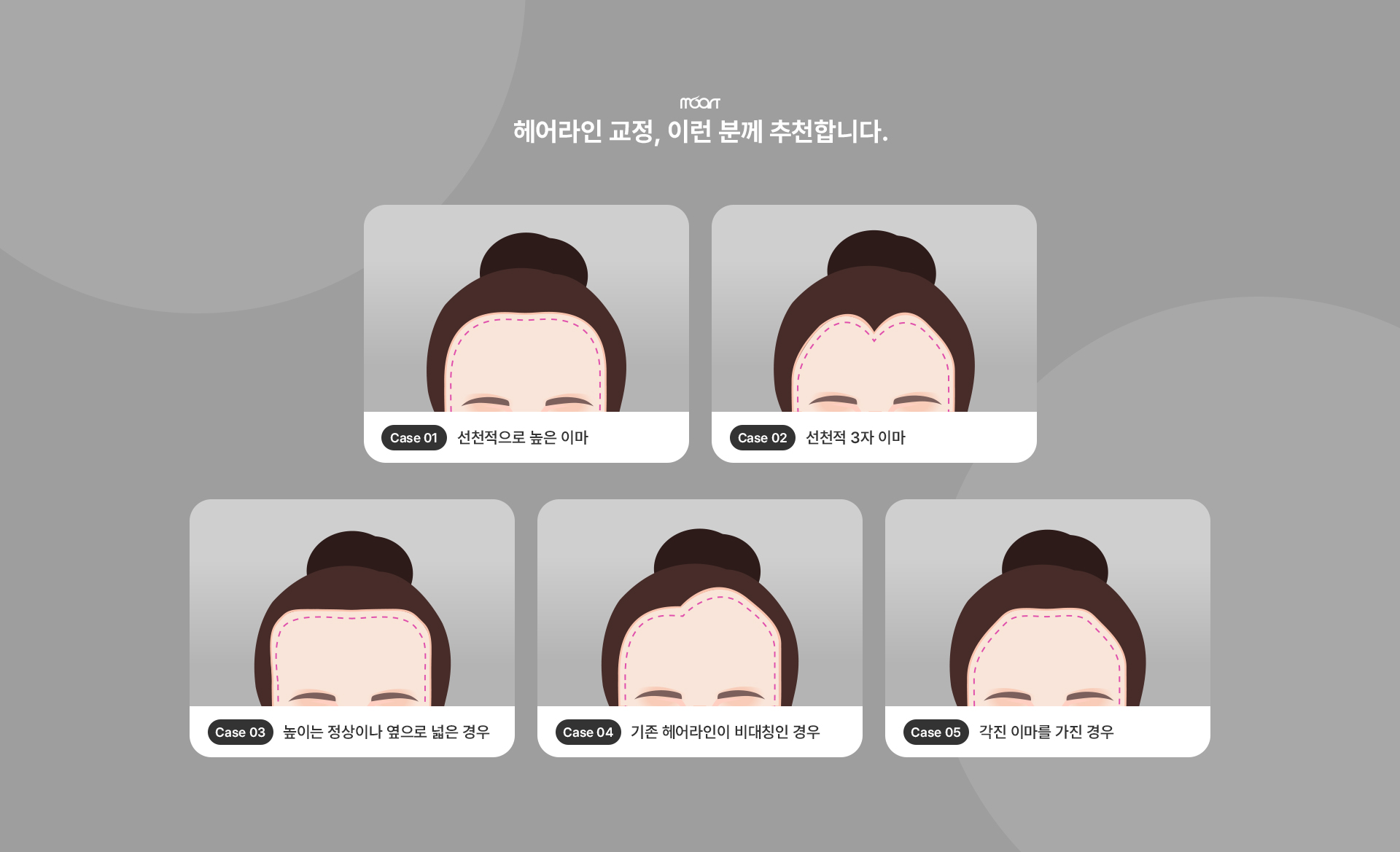 헤어라인교정 상세03